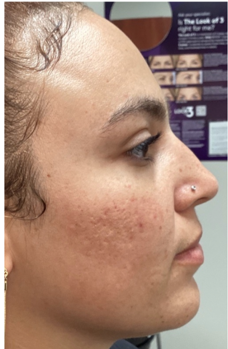 Before Image: Opus and ClearLift - right-side
